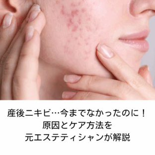 産後ニキビ…今までなかったのに!原因とケア方法を元エステティシャンが解説