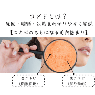 コメドとは？原因・種類・対策をわかりやすく解説【ニキビのもとになる毛穴詰まり】