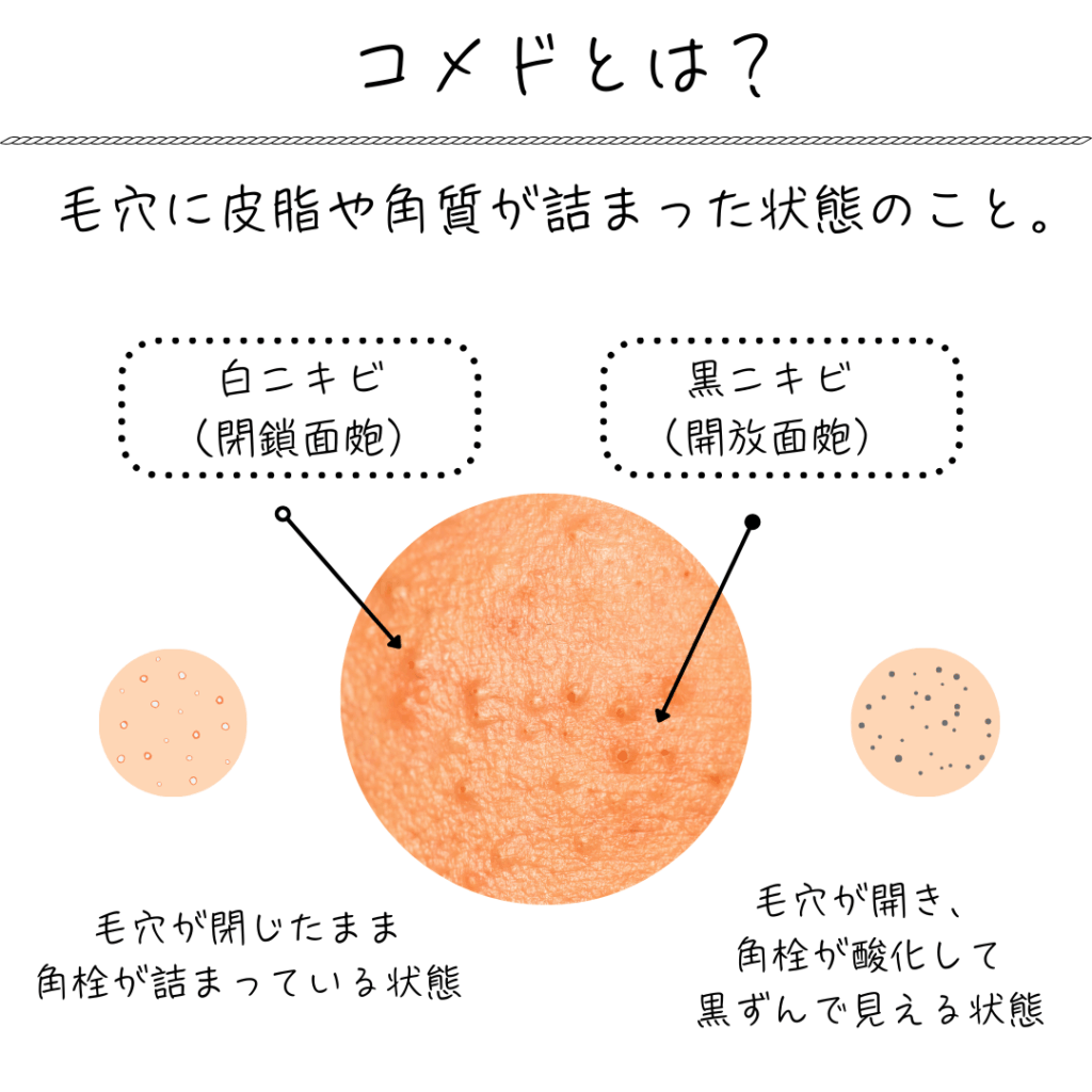 コメドとは?コメドの種類(白ニキビと黒ニキビの違いの図)