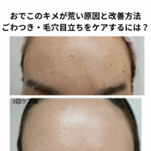 おでこのキメが荒い原因と改善方法|ごわつき・毛穴目立ちをケアするには?