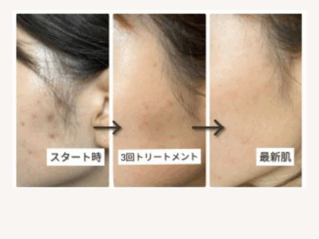 bihadapuroショップのスピキュールケアをセルフでした方のビフォーアフター