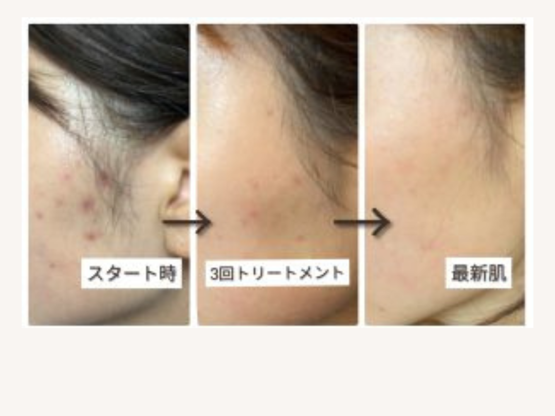 bihadapuroショップのスピキュールケアをセルフでした方のビフォーアフター