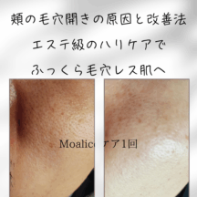 頬の毛穴開きの原因と改善法|エステ級のハリケアでふっくら毛穴レス肌へ