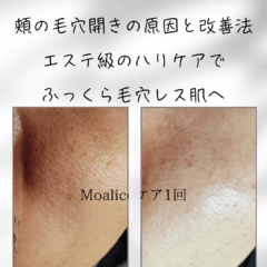 頬の毛穴開きの原因と改善法｜エステ級のハリケアでふっくら毛穴レス肌へ