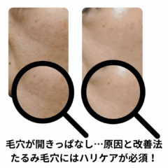 毛穴が開きっぱなし…原因と改善法｜たるみ毛穴にはハリケアが必須！