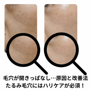 毛穴が開きっぱなし…原因と改善法｜たるみ毛穴にはハリケアが必須！