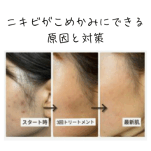 ニキビがこめかみにできる原因と対策|繰り返す人は生活習慣と肌ケアを見直して!