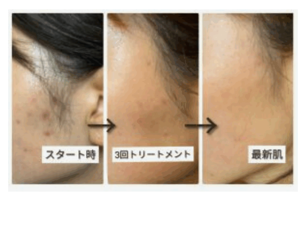 こめかみニキビの変化　スピキュールセルフケアでニキビケア