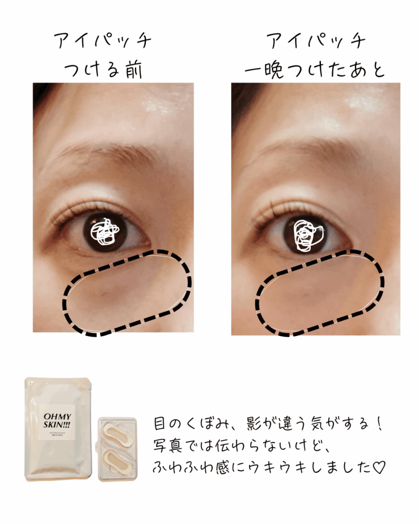 ヒアルロン酸ニードルアイパッチのビフォーアフター