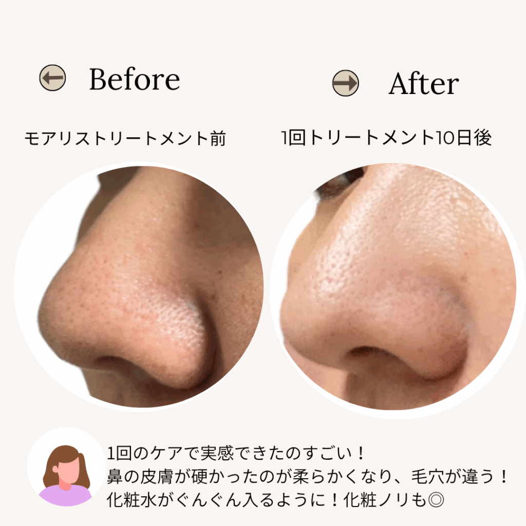 鼻の毛穴悩みにモアリストリートメント1回した時の比較写真