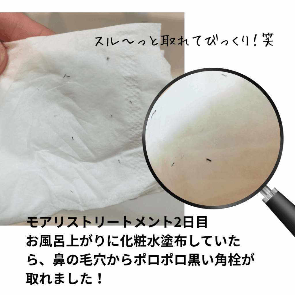 Moaliceトリートメントで排出された角栓の写真