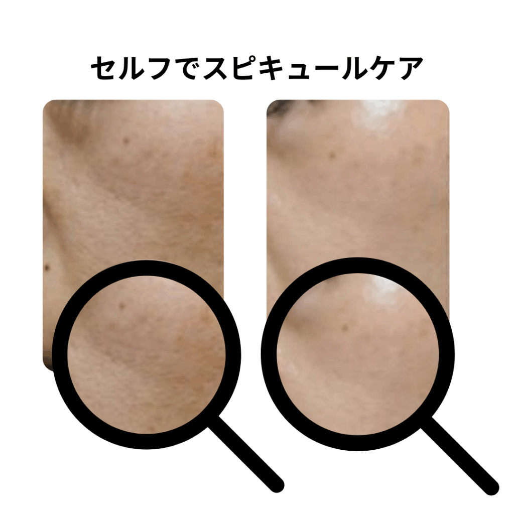 毛穴開きスキンケアの本格アイテム、スピキュールケアをセルフでした