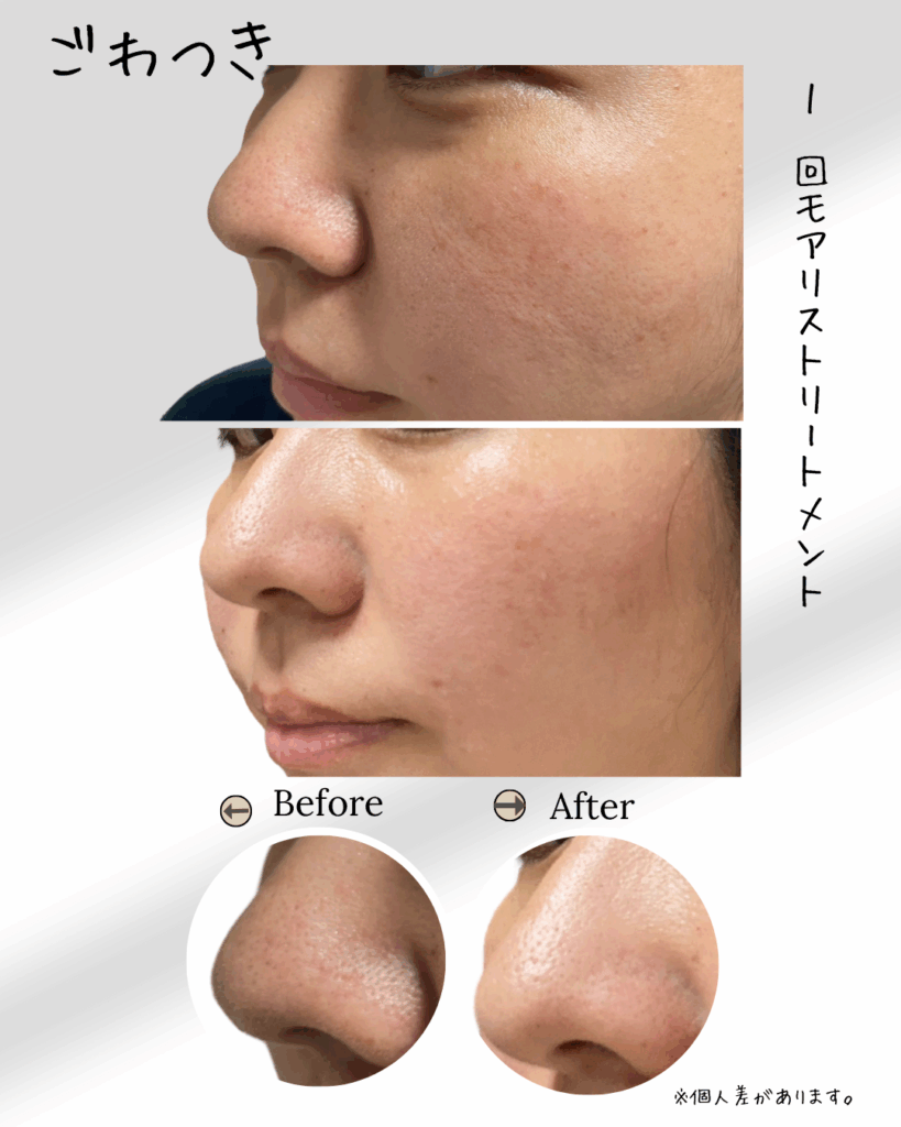 スピキュールセルフケアMoaliceトリートメントをした人のbefore-after