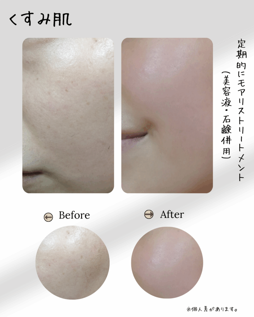 スピキュールセルフケアMoaliceトリートメントをした人のbefore-after