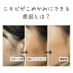 こめかみニキビの原因は？考えられる理由をわかりやすく解説