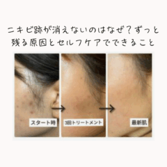 ニキビ跡が消えないのはなぜ？ずっと残る原因とセルフケアでできること