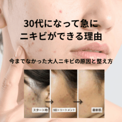 30代になって急にニキビができる理由｜今までなかった大人ニキビの原因と整え方