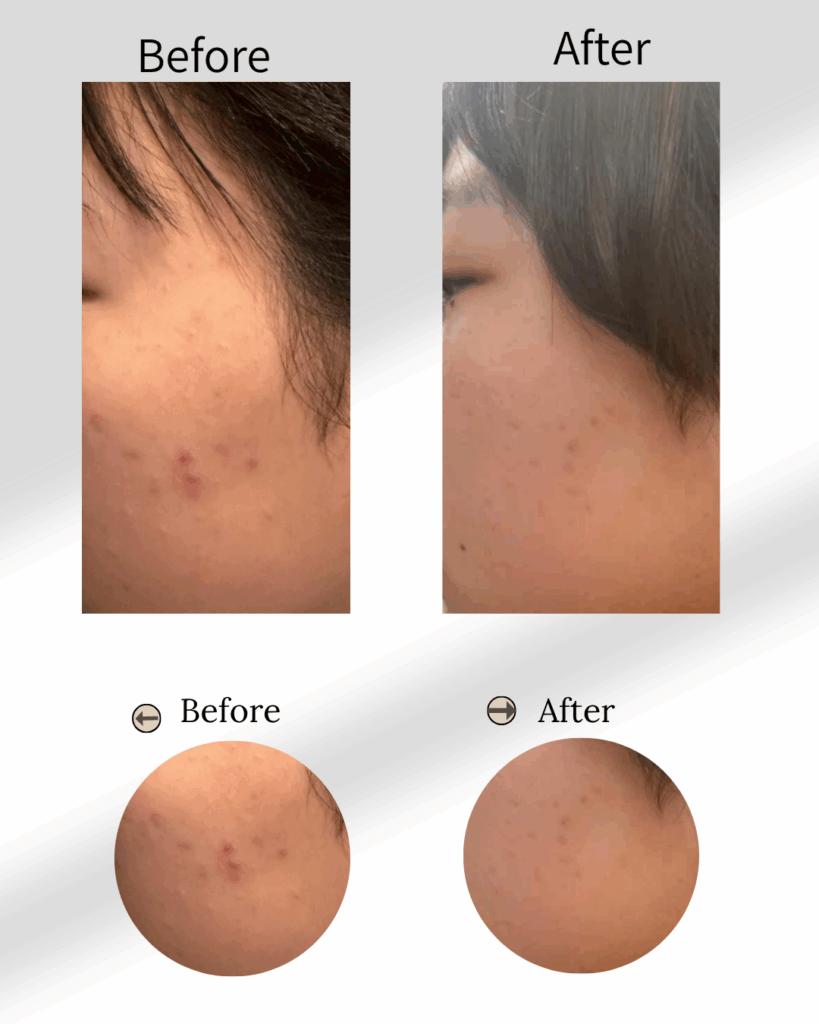 もみあげ付近のニキビ悩みに、MoaliceトリートメントをしたBefore-After