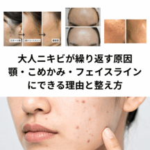 大人ニキビ繰り返す原因｜顎・こめかみ・フェイスラインにできる理由と整え方
