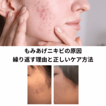 もみあげニキビの原因｜繰り返す理由と正しいケア方法【大人ニキビにも】