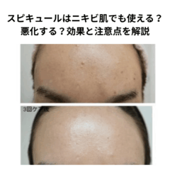 スピキュールはニキビ肌でも使える？悪化する？効果と注意点を解説