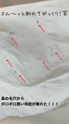 スピキュールケア（モアリストリートメント）をした翌日から鼻の黒ずみがポロポロとれた黒い角栓の写真