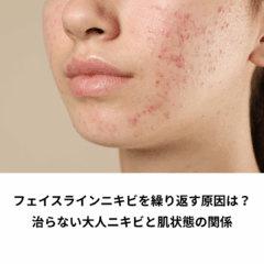 フェイスラインニキビを繰り返す原因は？治らない大人ニキビと肌状態の関係