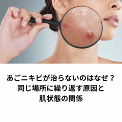 あごニキビが治らないのはなぜ？同じ場所に繰り返す原因と肌状態の関係