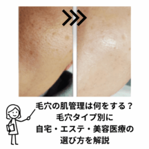 毛穴の肌管理は何をする？毛穴タイプ別に自宅・エステ・美容医療の選び方を解説